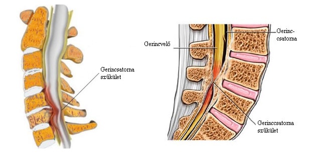 nyaki osteochondrosis az akut stádiumban erős fájdalom a hüvelykujj ízületében